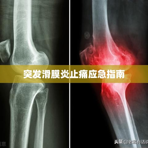 突发滑膜炎止痛应急指南