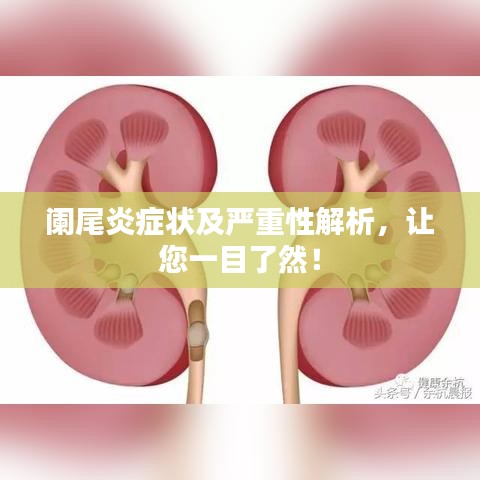 阑尾炎症状及严重性解析,让您一目了然!