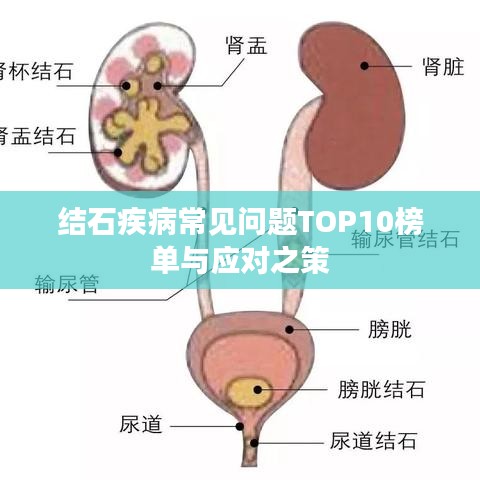 结石疾病常见问题TOP10榜单与应对之策