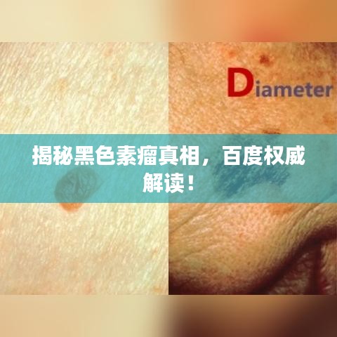 揭秘黑色素瘤真相,百度权威解读!
